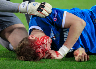 Illustration for article titled Zenit Player's Face Was A River Of Blood After Getting Kneed In Head